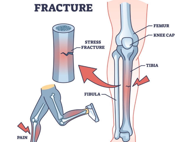 Trauma and Fracture Management 1 trauma
